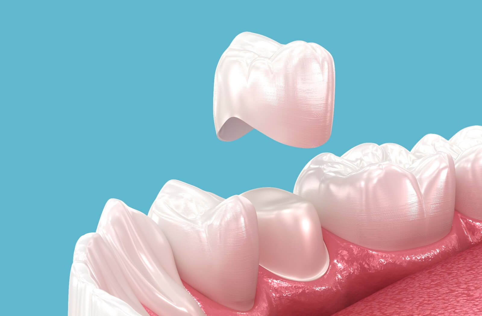 Close-up of a same-day dental crown being placed on a tooth