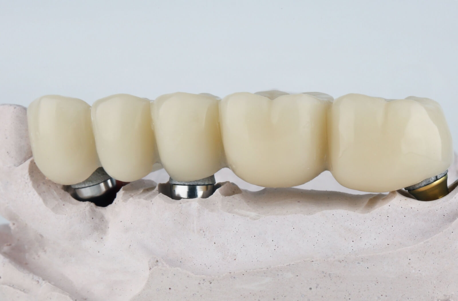 Bridges and implants come in different varieties, and can even be combined. A model of a dental implant, bridging the gap between implant locations is depicted.