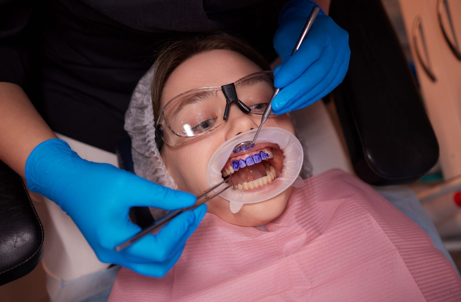 Someone has disclosure dye painted on their teeth in preparation for Guided Biofilm Therapy.